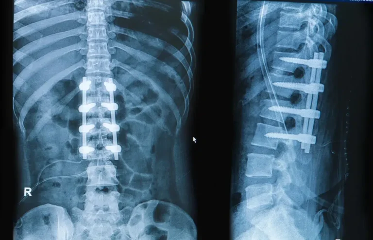 🦴 Motion Preservation in Spine Surgery: Cervical and Lumbar Disc Prostheses