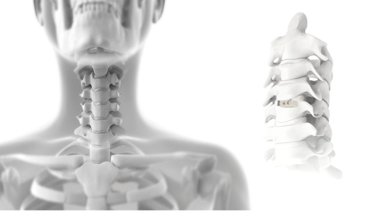 Prótesis de disco cervical: una alternativa para tratar el dolor cervical y preservar el movimiento
